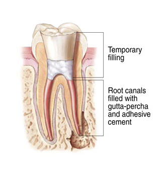 Tooth with Temporary Filling